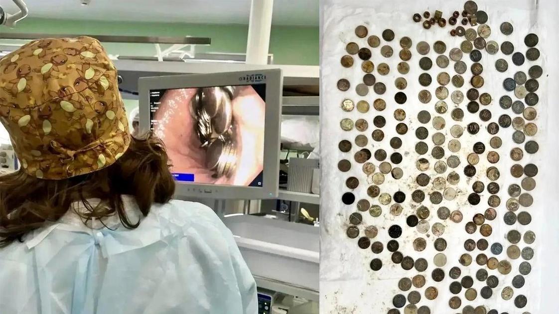 В Волгограде из желудка мужчины достали 200 монет, 11 гаек и скобы от шпингалета  (Психология)